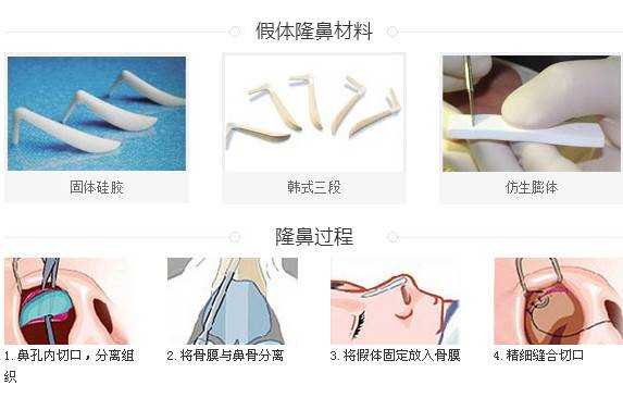 揭秘，当下最热门的隆鼻新技术！