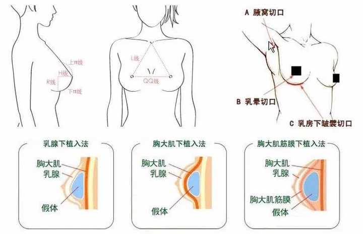 最新隆胸方法揭秘，当下最受欢迎的隆胸方式与趋势