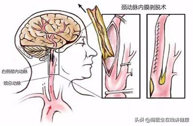 脑梗塞最新治疗方法研究及进展